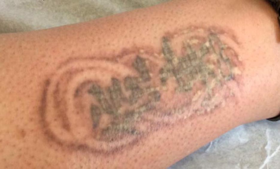 Laser Tattoo Removal Services in Southwest Florida