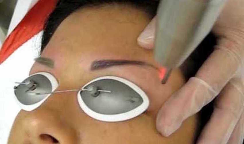 Permanent Makeup Eyebrow Tattoo Removal