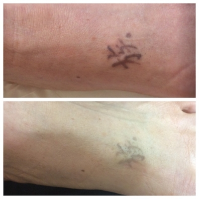 Laser Tattoo Removal Services in Fort Myers and Naples, FL - (239) 431-5432