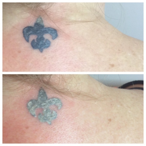 Laser Tattoo Removal Services in Fort Myers and Naples, FL - (239) 431-5432