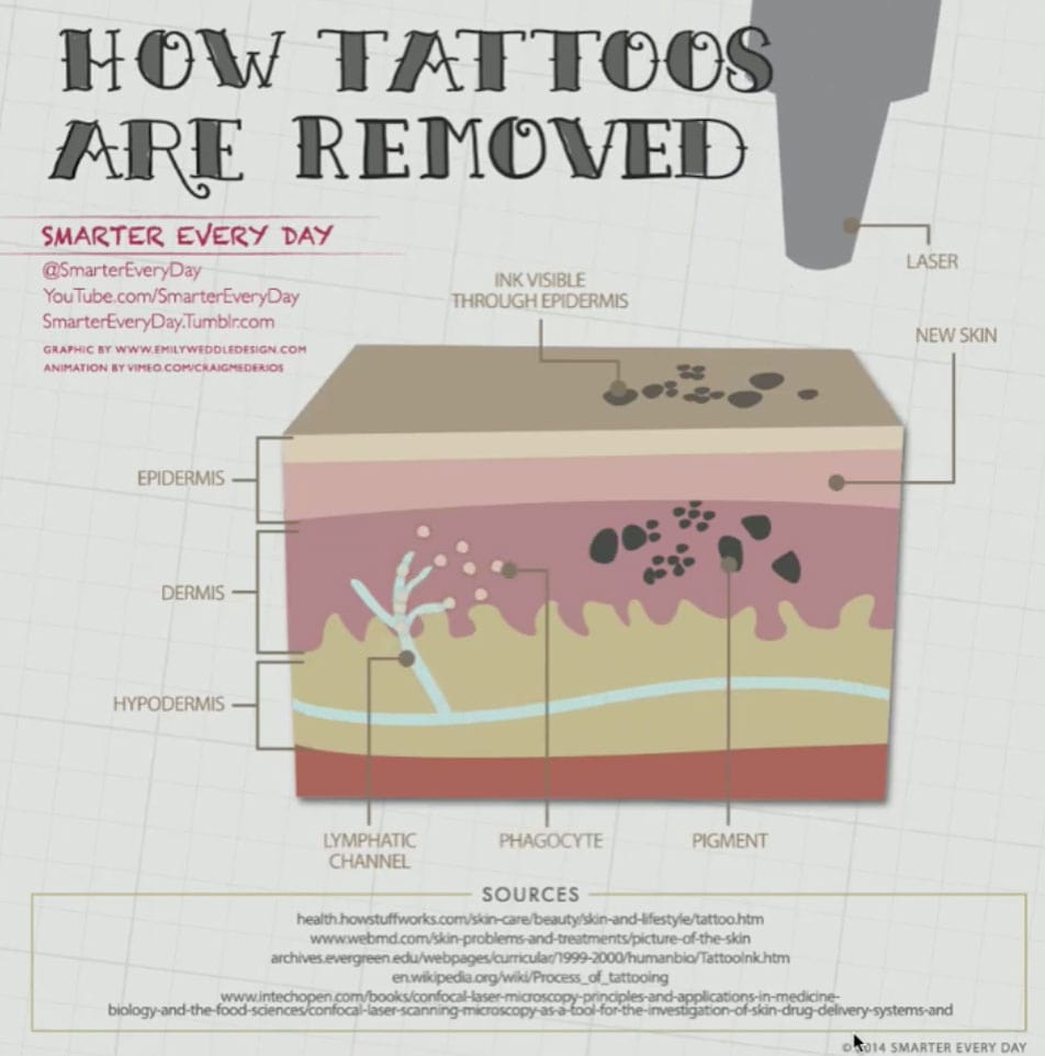 Laser Tattoo Removal Aftercare, A Comprehensive Guide (239) 3097246